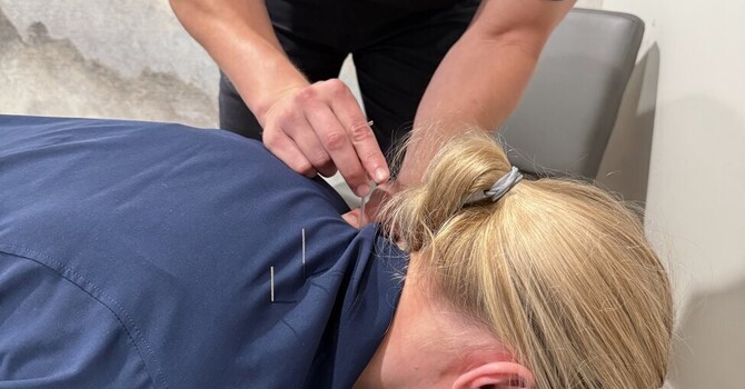 Tension Headaches & “Tech Neck”: How Chiropractic and Dry Needling Help